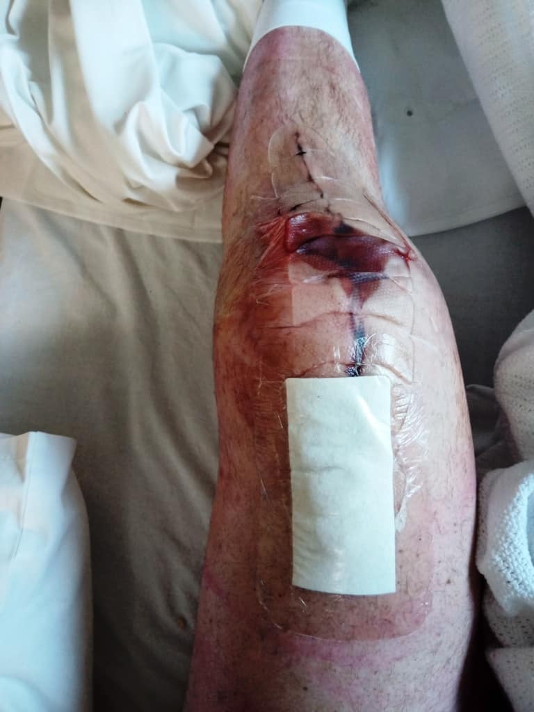 Knee Replacement after
