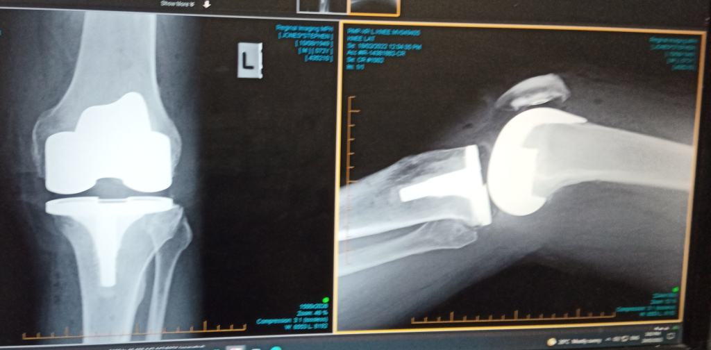 Knee replacement X-ray after