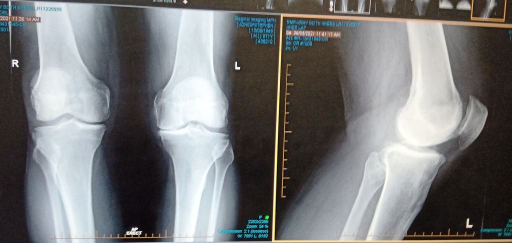 Knee replacement X-Ray Before