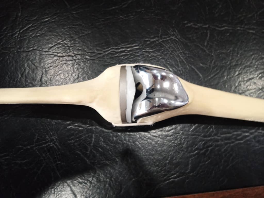 Knee Replacement