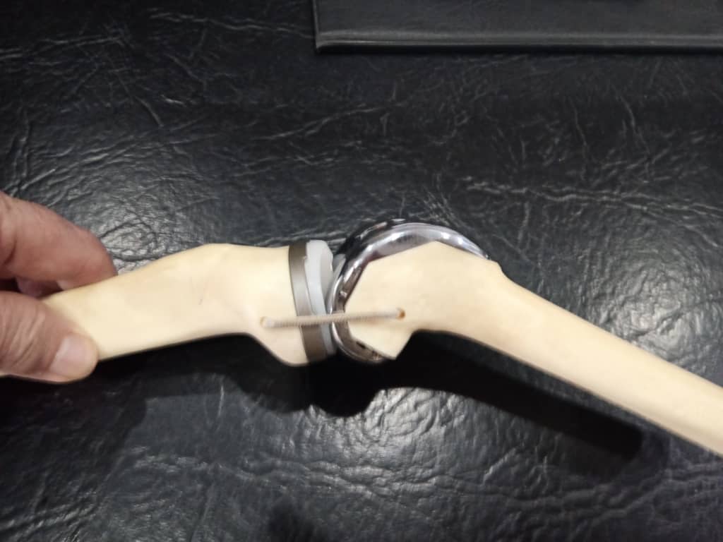 Knee replacement
